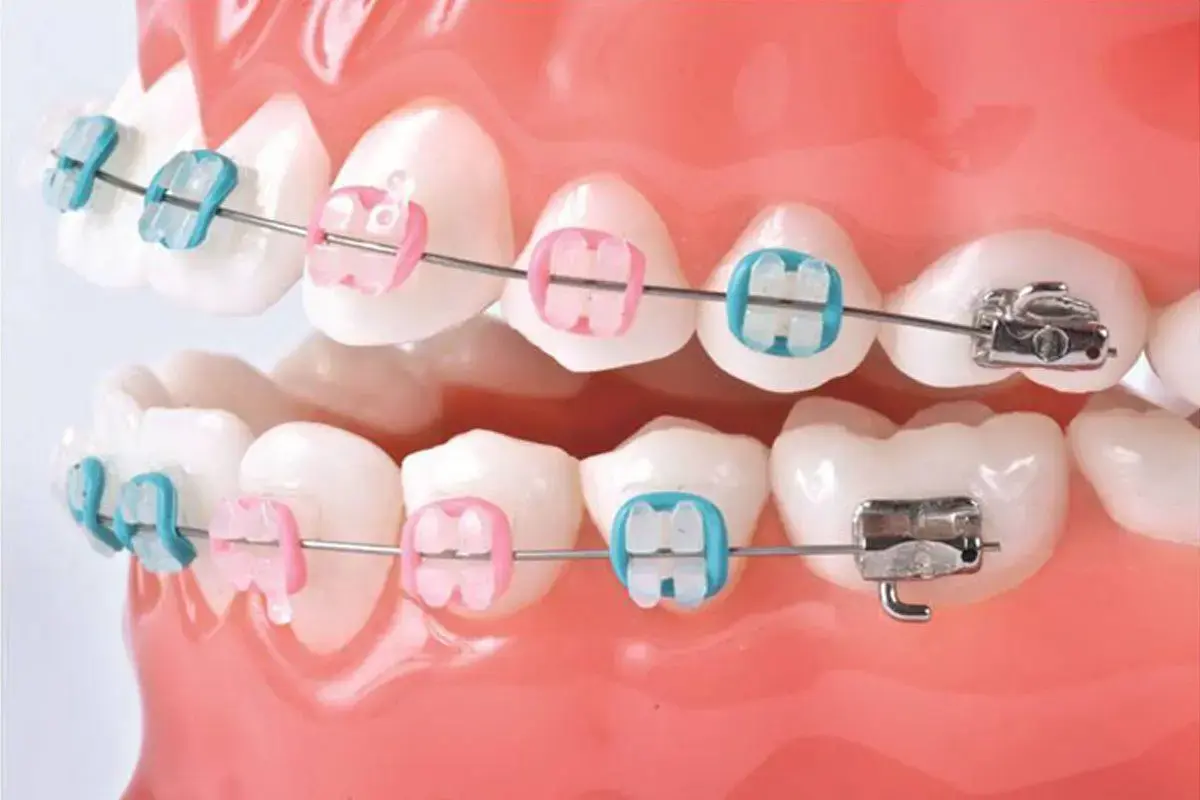 ارتودنسی ثابت