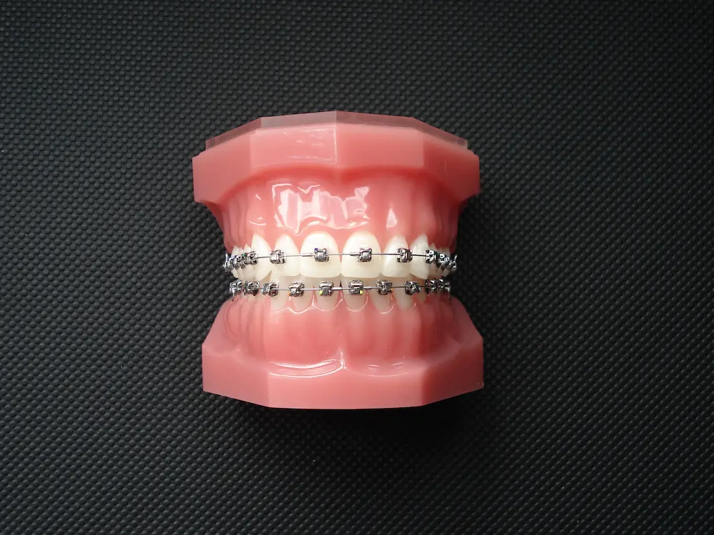 بهترین دکتر ارتودنسی ثابت در تهران