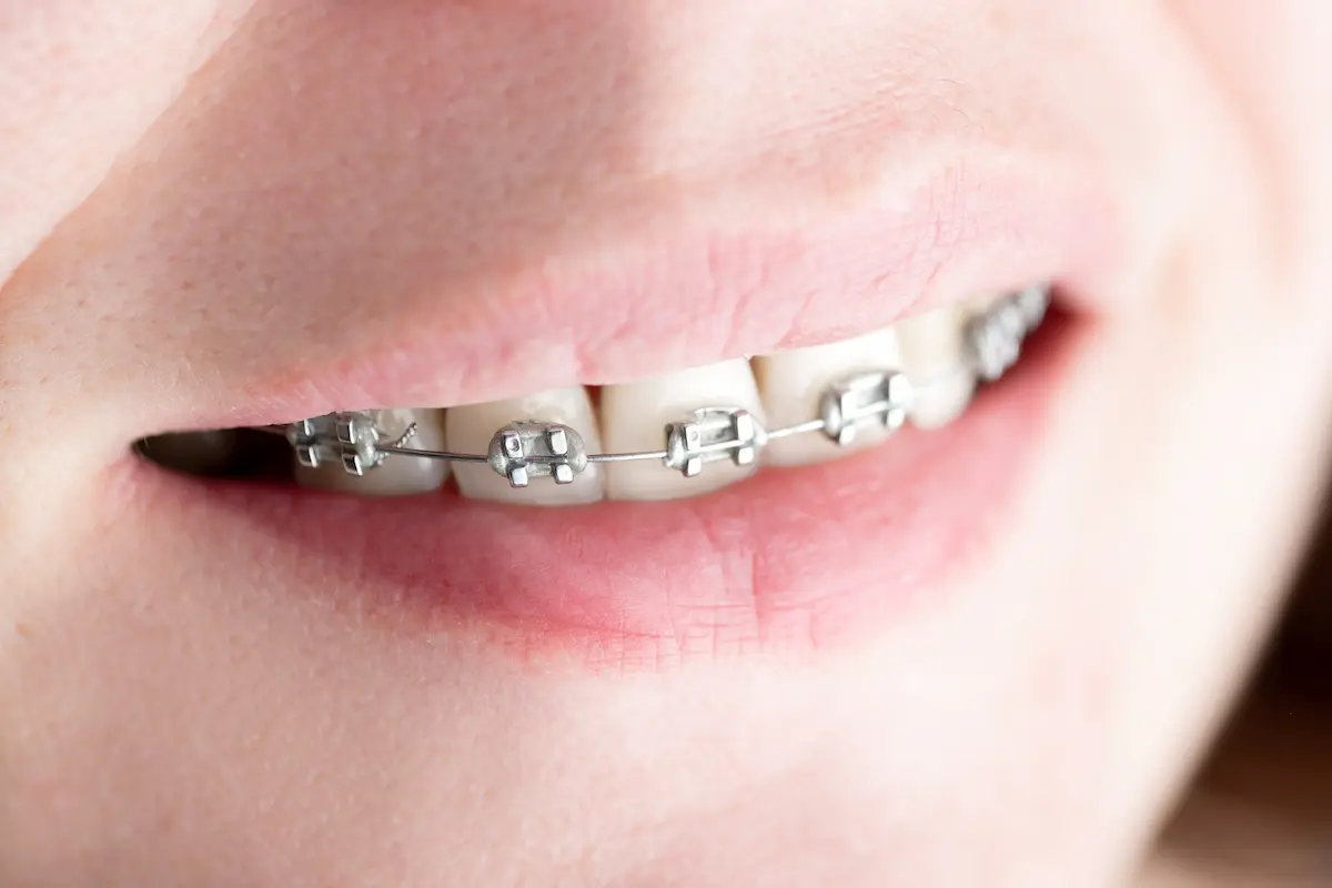 براکت ارتودنسی