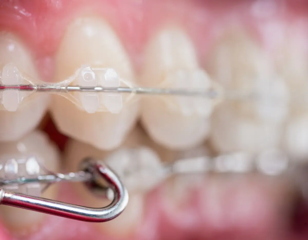 براکت ارتودنسی شفاف