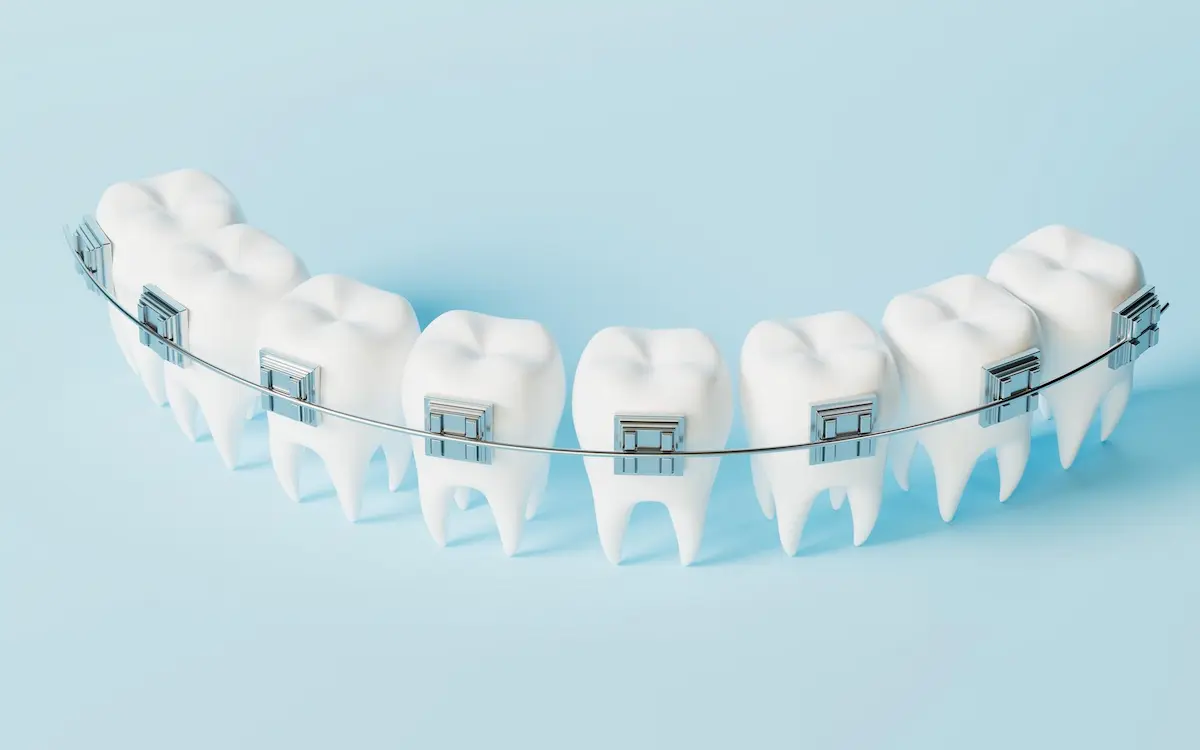 تصویر ارتودنسی دندان