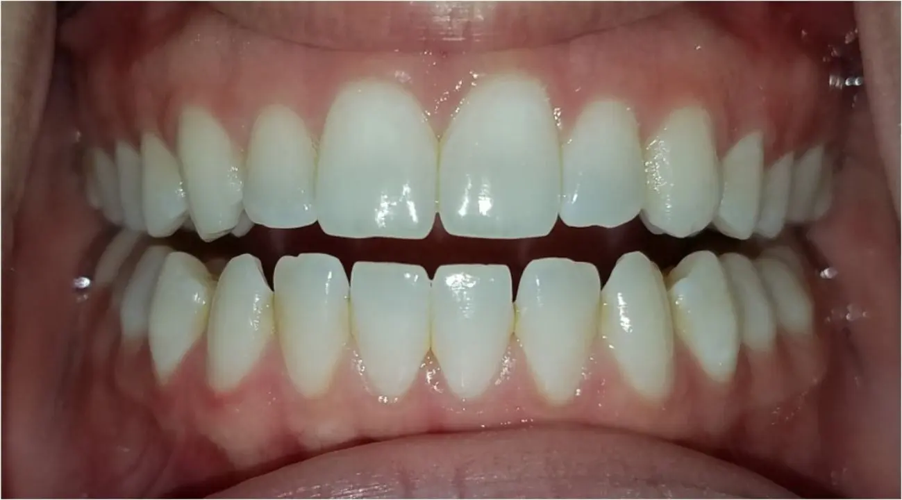 روش های درمان اپن بایت