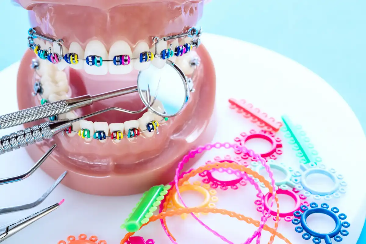 هزینه کش ارتودنسی